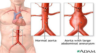 Normal aorta versus aorta with large abdominal aneurism.