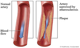 Normal artery versus artery narrowed by atherosclerosis.